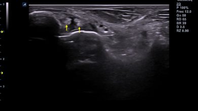 Photo of Rotura completa del ligamento peroneo astragalino anterior